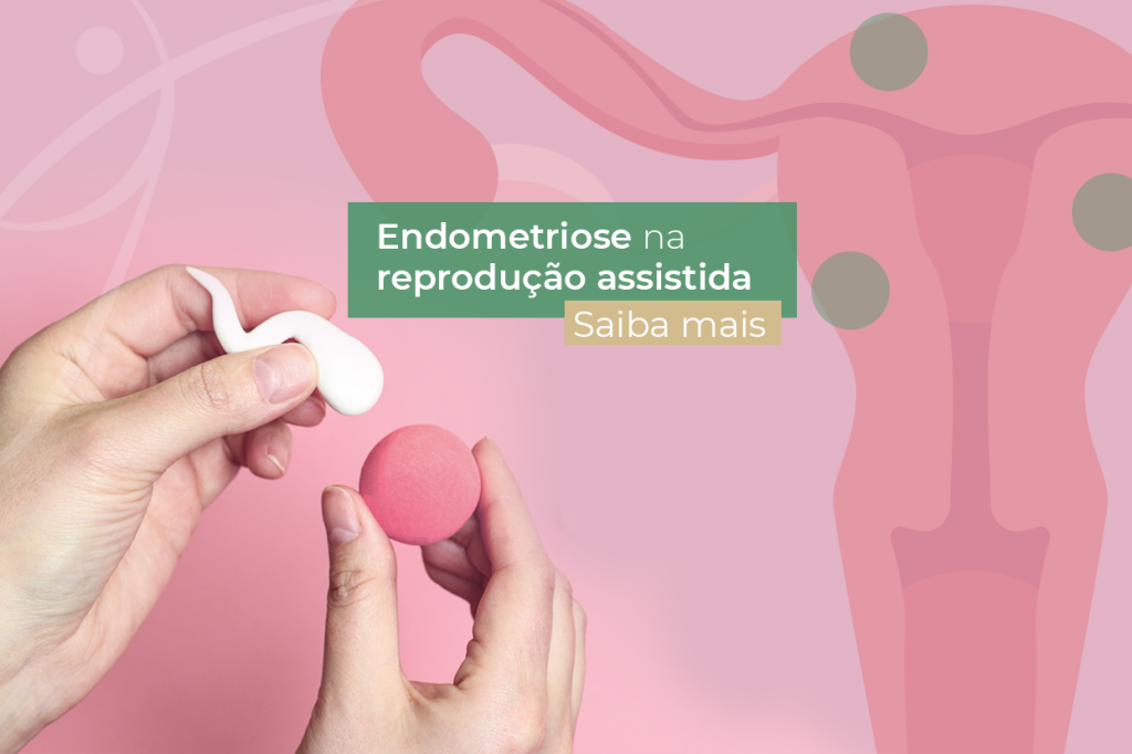 Endometriose Na Reprodu O Assistida Adriana De Goes