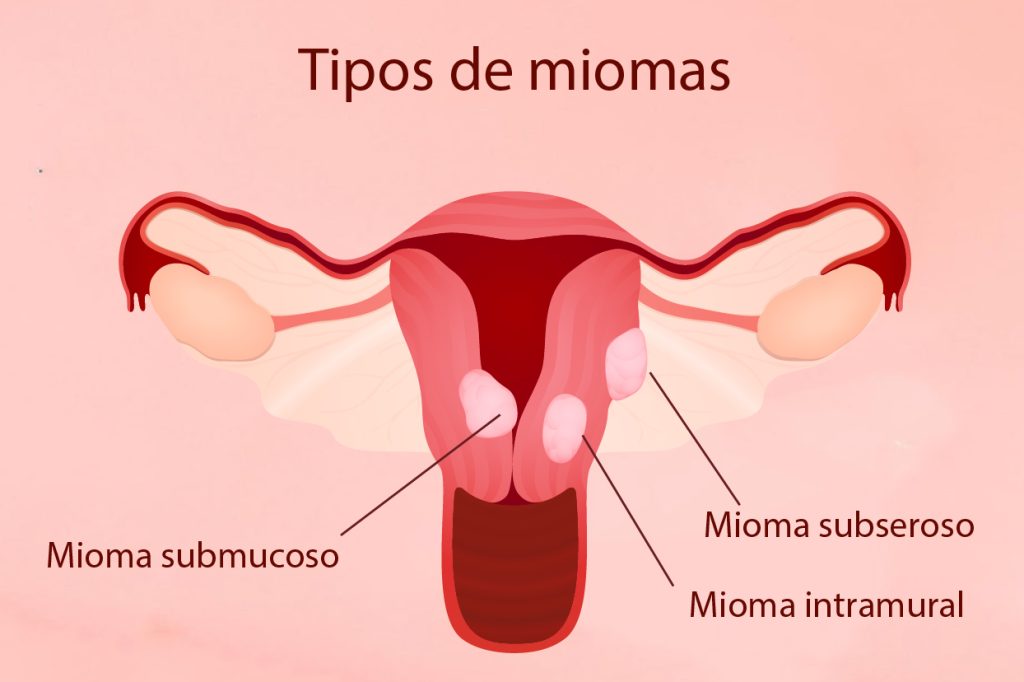 Mioma submucoso e infertilidade existe relação Adriana de Goes