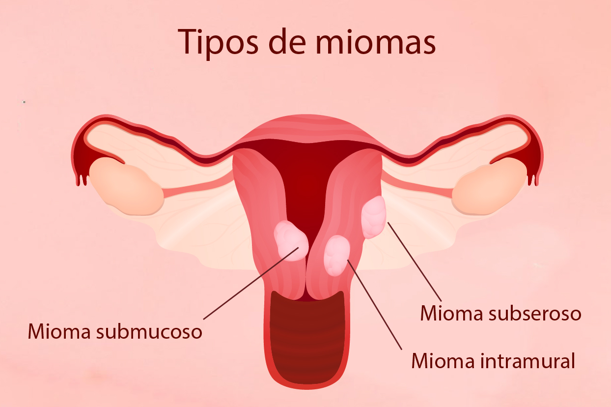 Mioma submucoso e infertilidade: existe relação? - Adriana de Goes