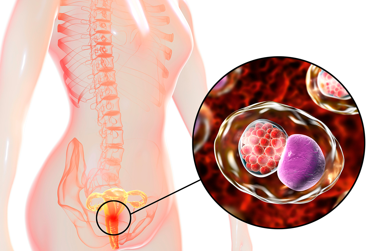 Endometrite: o que é?